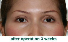 plastic-surgery-blepharoplasty